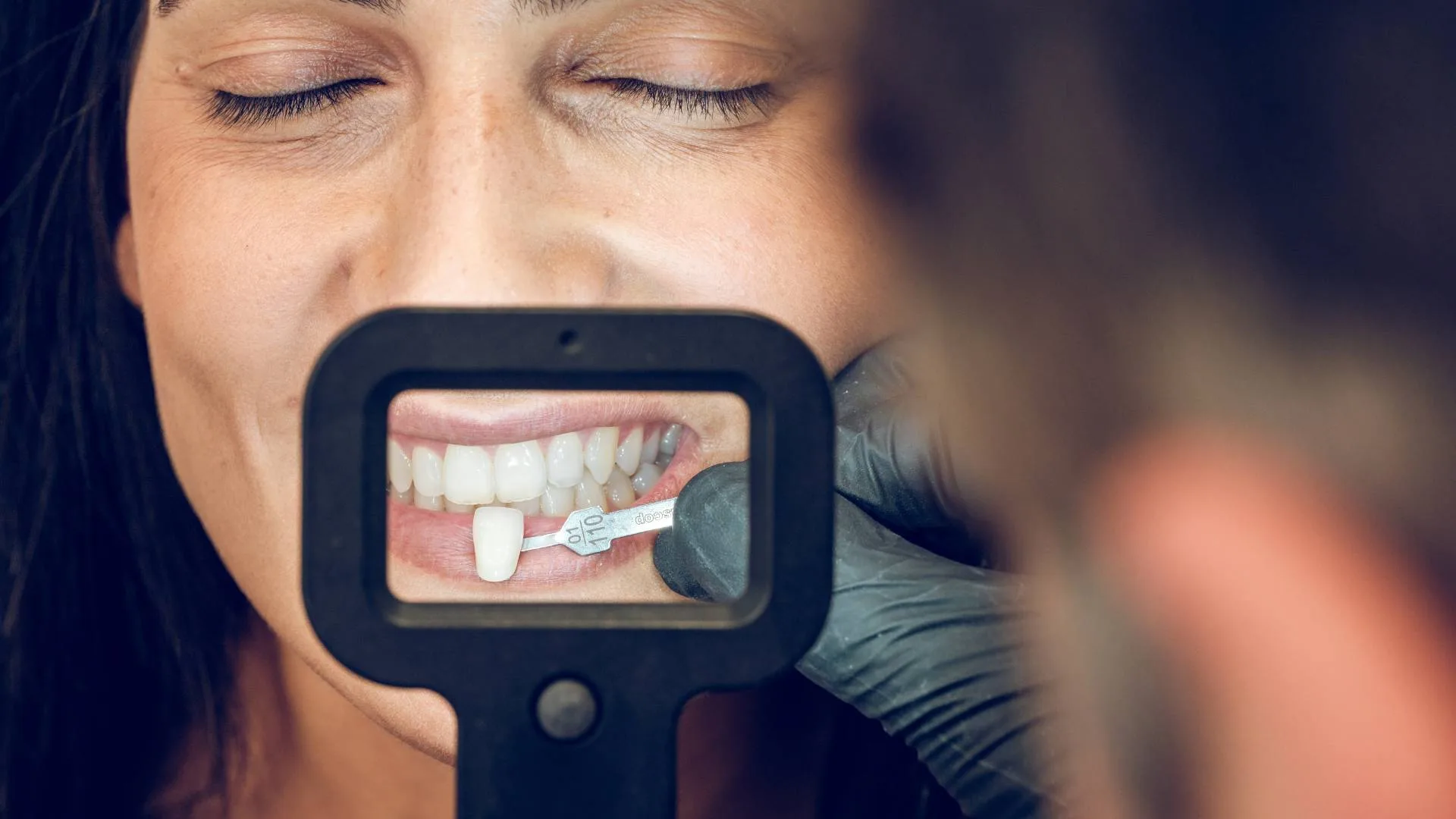 faccette dentali 3 | faccettadentale.it