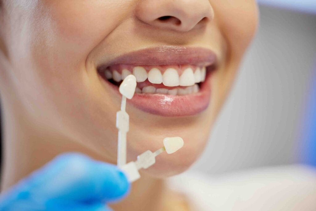 Faccette dentali a montebelluna