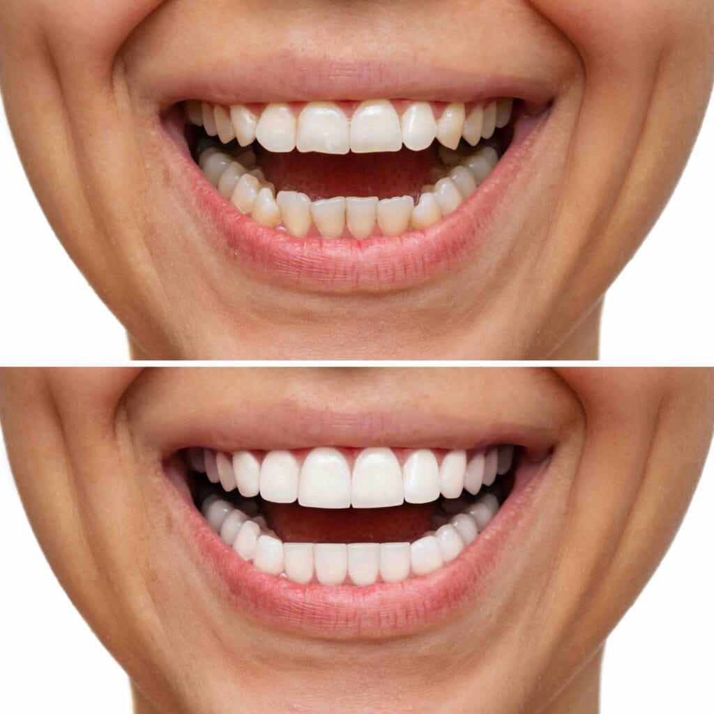 Faccette dentali a Como
