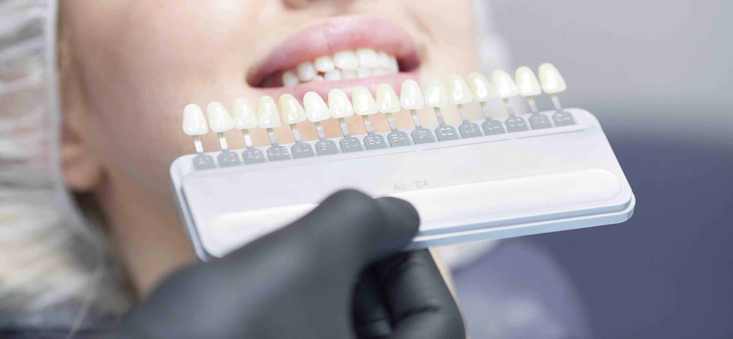 Faccette dentali preparazione al trattamento