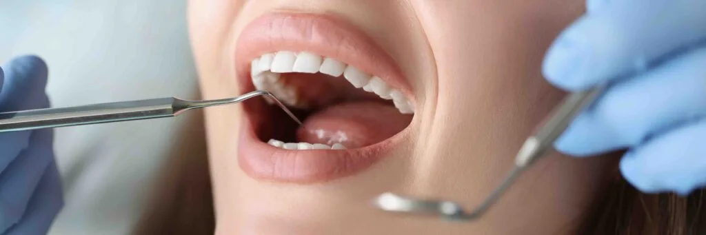 sbiancamento con faccette dentali