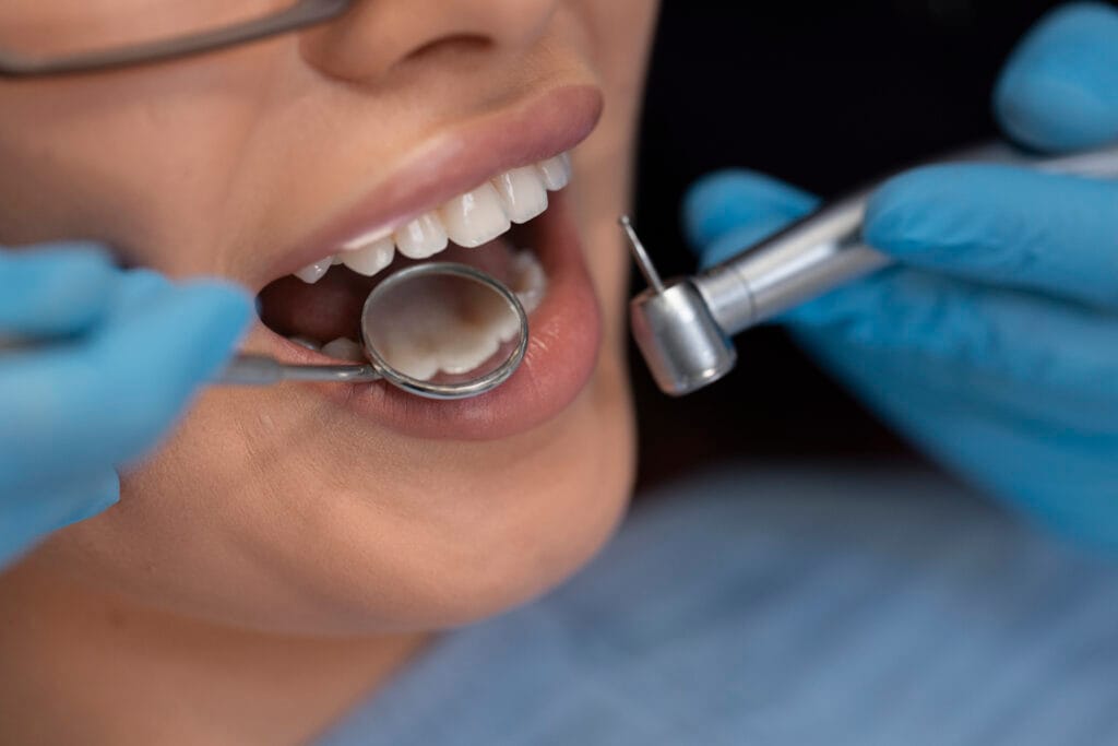 quante sedute servono per le faccette dentali