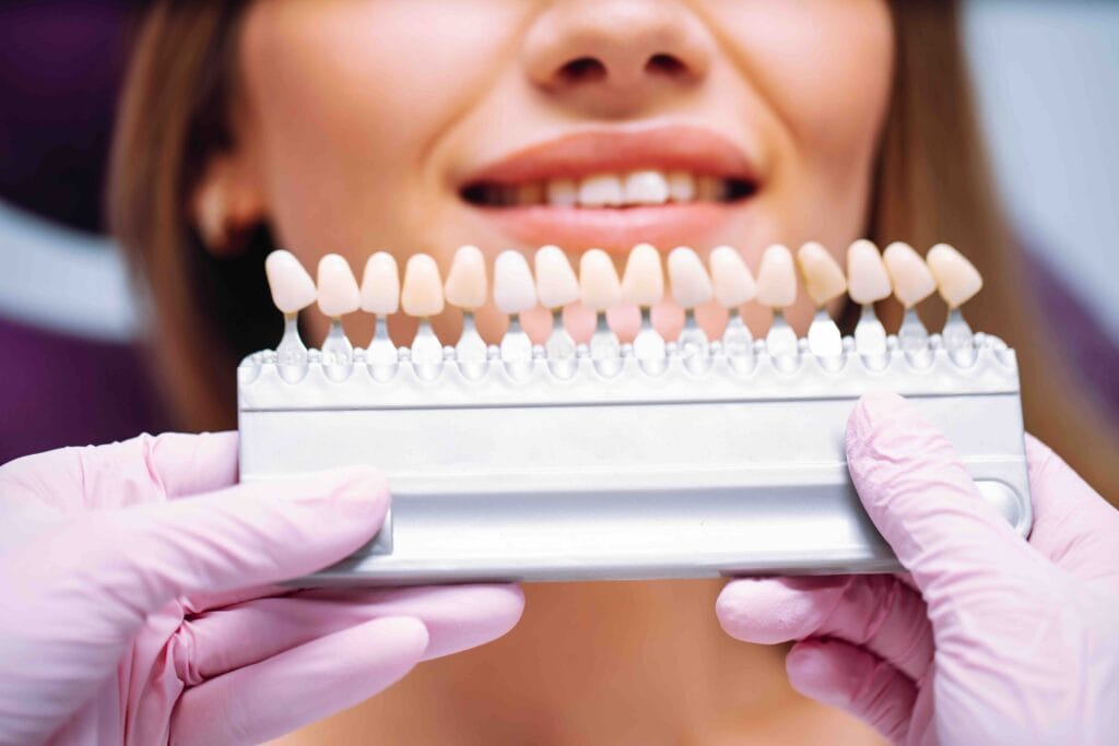 Faccette dentali e gengive sensibili