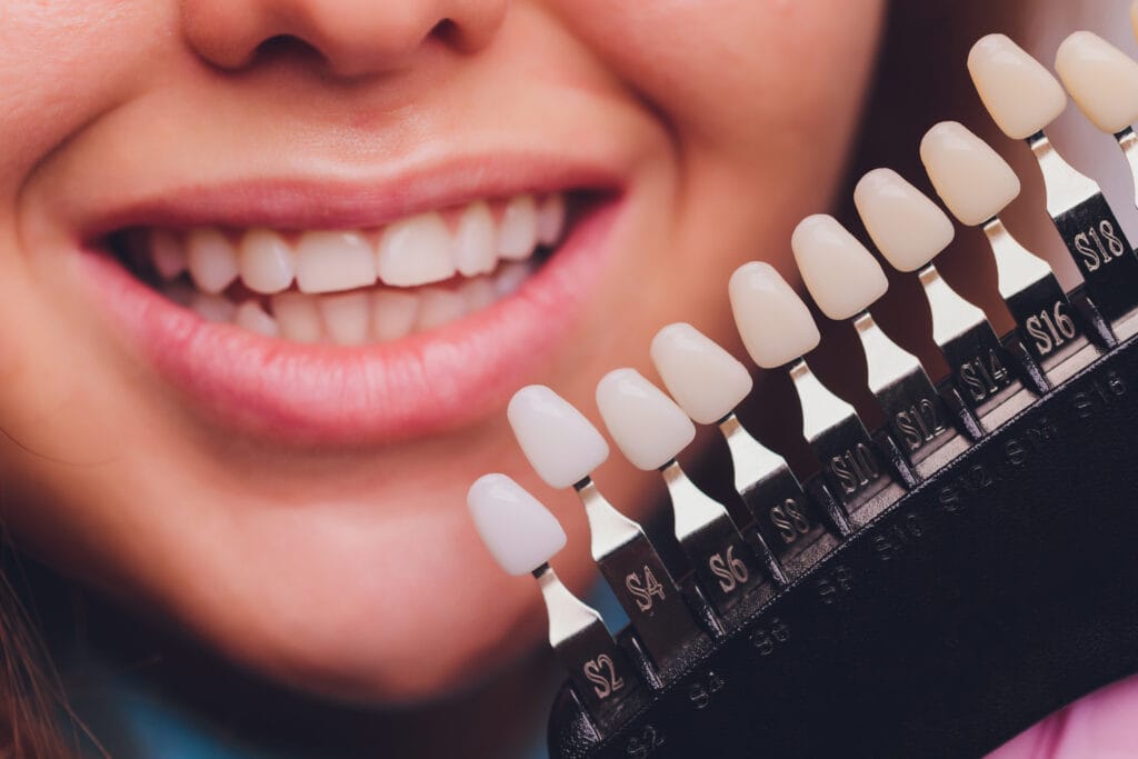 faccette dentali cosa sono