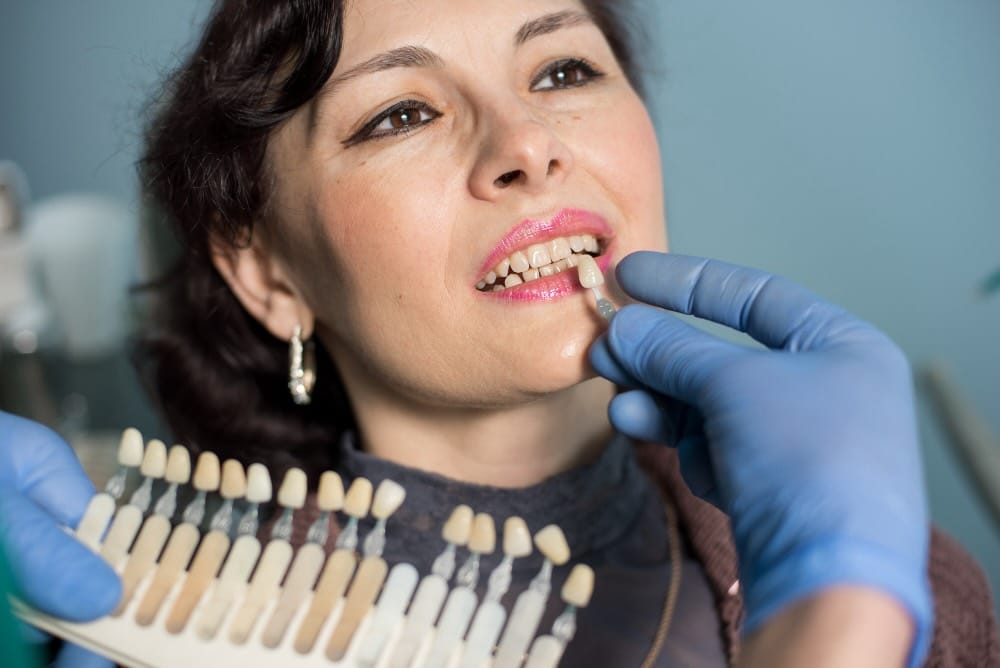 faccette dentali resistenti alle macchie