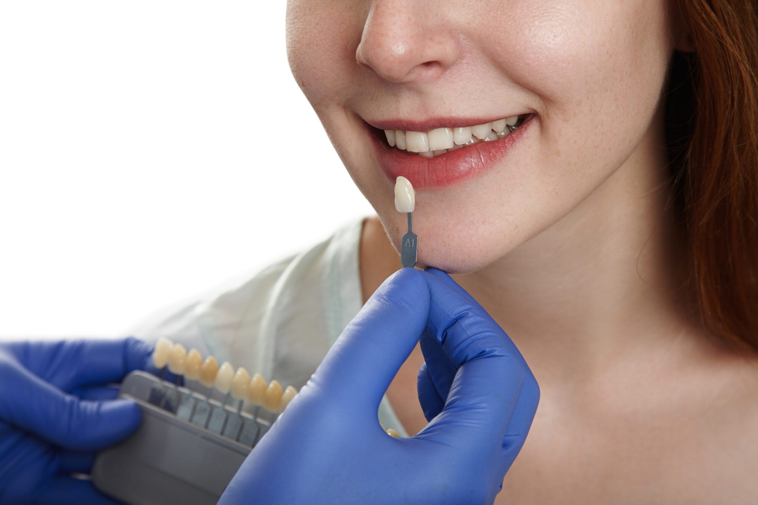 Faccette dentali in composito