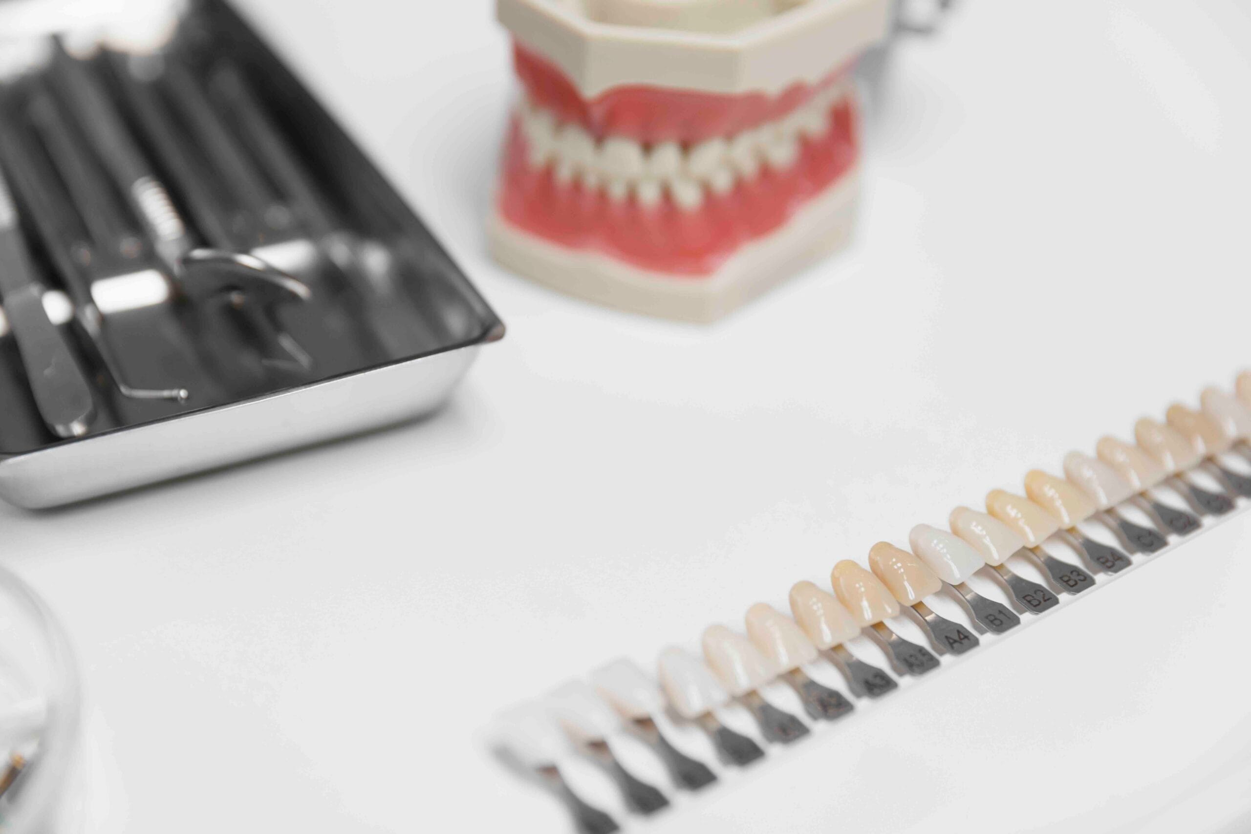 faccette dentali o impianti
